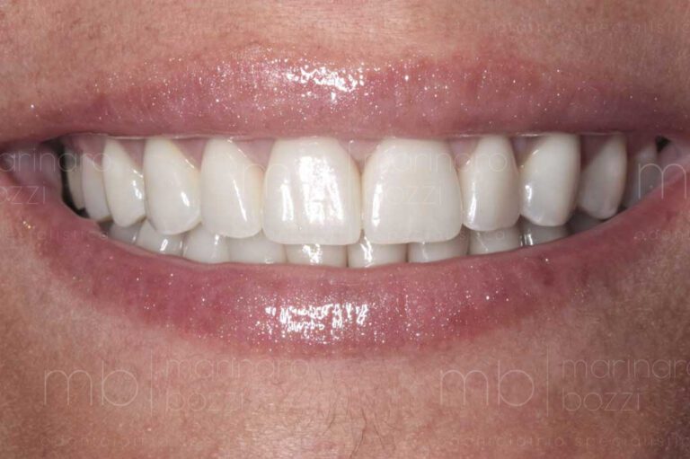 Protesi Estetica a Bari presso Studio Dentistico Marinaro Bozzi