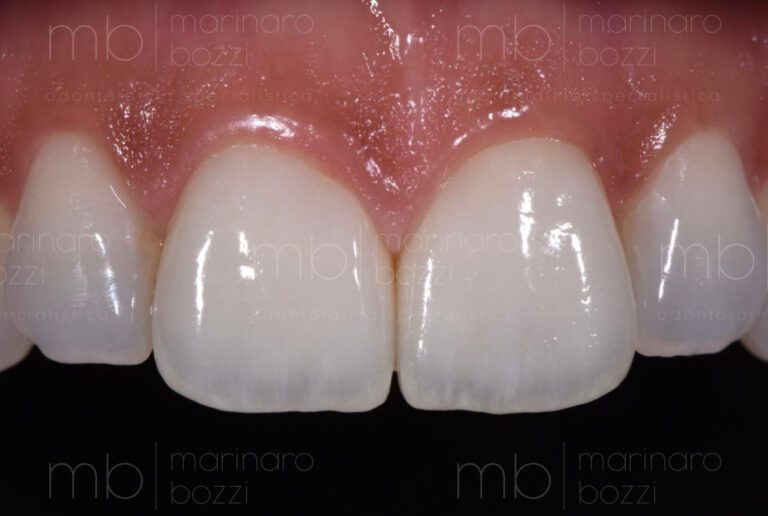 Faccette Estetiche Bari Studio Dentistico Marinaro Bozzi