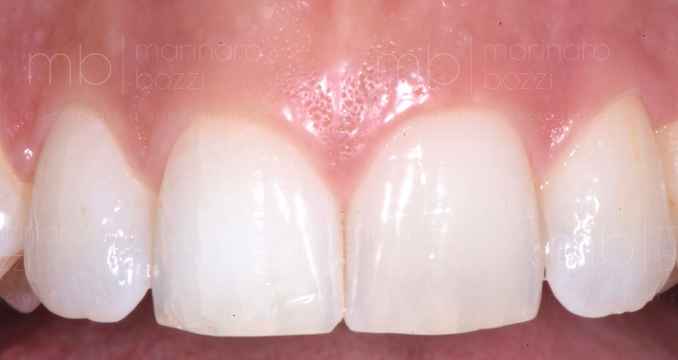 Sbiancamento interno dente devitalizzato a Bari