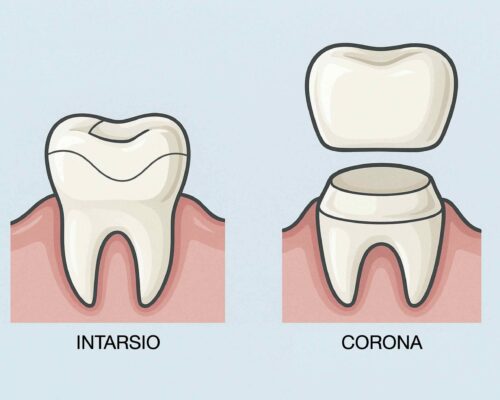 Differenze tra intarsio e corona dentale