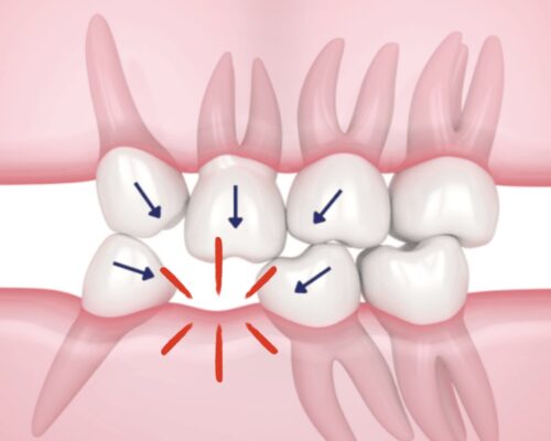 Perché è importante sostituire subito un dente mancante